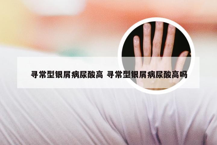寻常型银屑病尿酸高 寻常型银屑病尿酸高吗