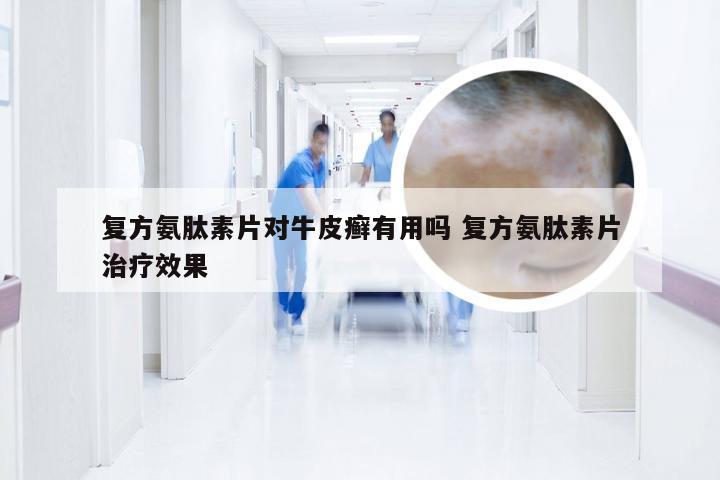复方氨肽素片对牛皮癣有用吗 复方氨肽素片治疗效果