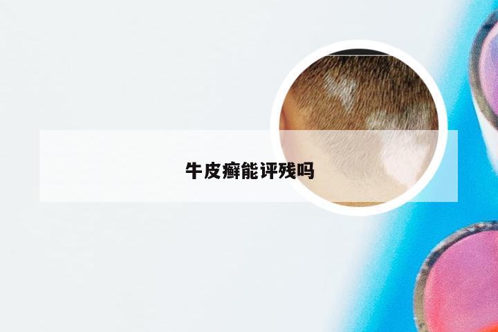 牛皮癣能评残吗