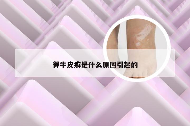 得牛皮癣是什么原因引起的