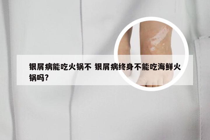 银屑病能吃火锅不 银屑病终身不能吃海鲜火锅吗?