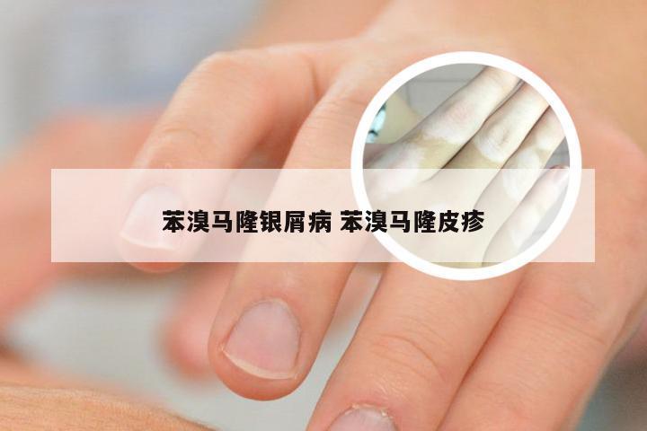 苯溴马隆银屑病 苯溴马隆皮疹