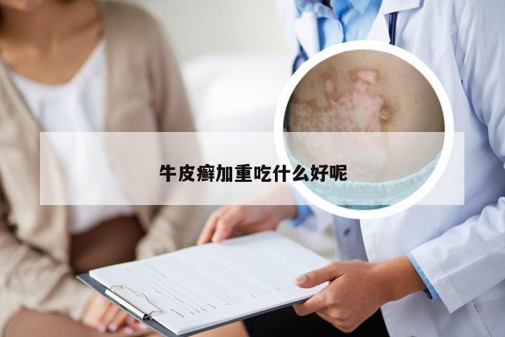 牛皮癣加重吃什么好呢