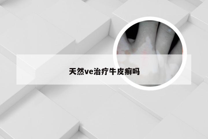 天然ve治疗牛皮癣吗