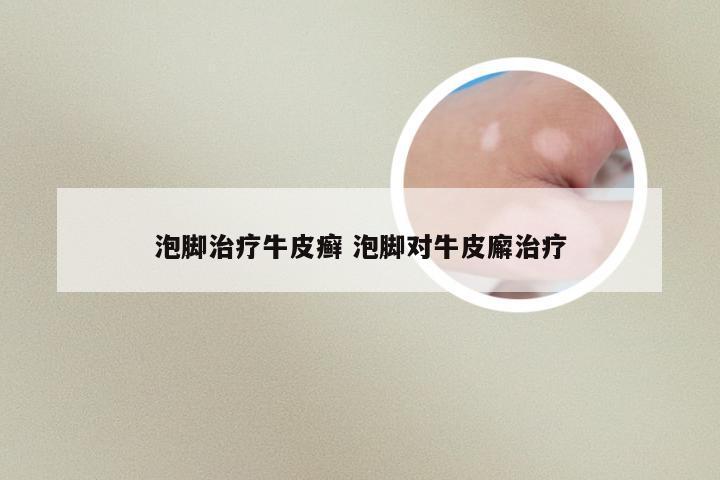 泡脚治疗牛皮癣 泡脚对牛皮廨治疗