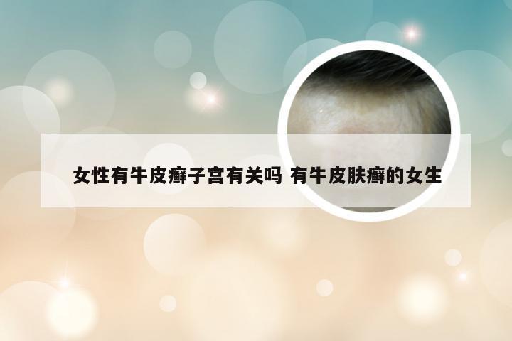 女性有牛皮癣子宫有关吗 有牛皮肤癣的女生