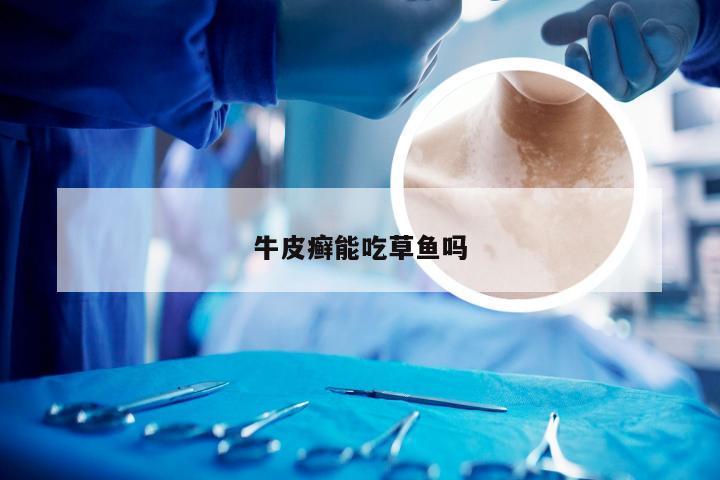 牛皮癣能吃草鱼吗
