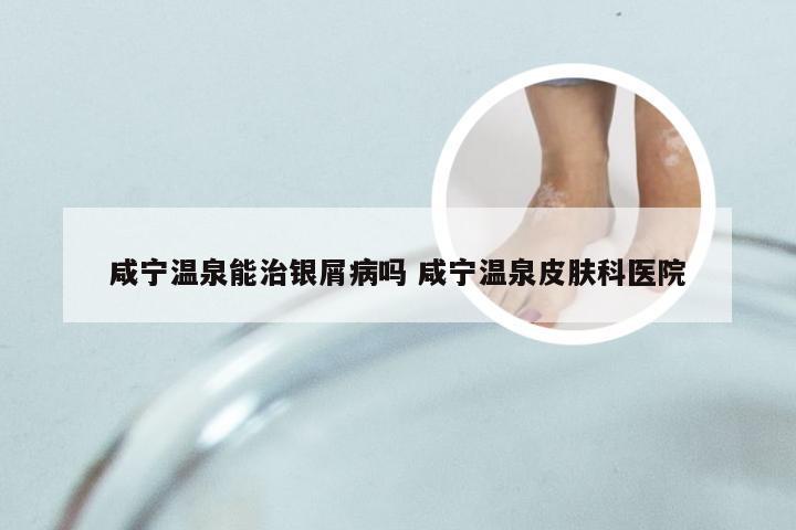 咸宁温泉能治银屑病吗 咸宁温泉皮肤科医院