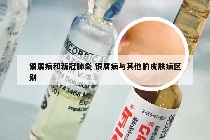 银屑病和新冠肺炎 银屑病与其他的皮肤病区别
