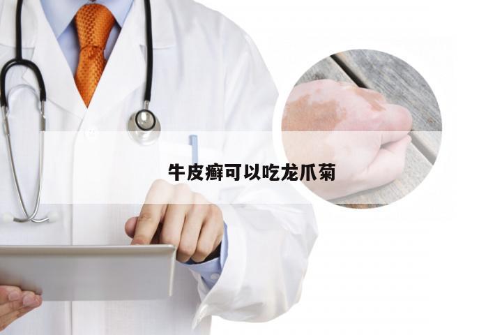 牛皮癣可以吃龙爪菊