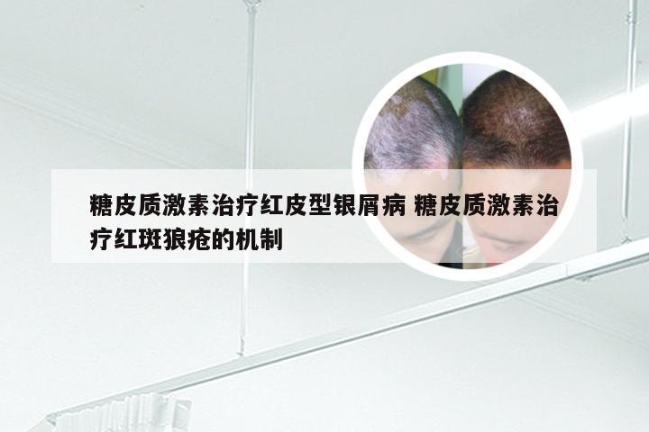 糖皮质激素治疗红皮型银屑病 糖皮质激素治疗红斑狼疮的机制