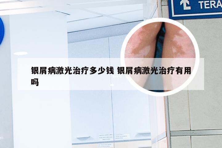 银屑病激光治疗多少钱 银屑病激光治疗有用吗