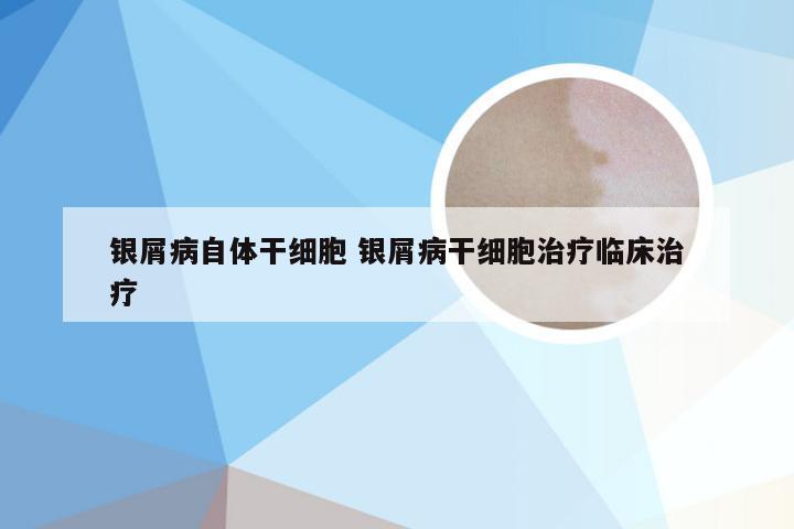 银屑病自体干细胞 银屑病干细胞治疗临床治疗
