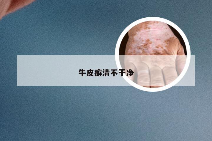 牛皮癣清不干净
