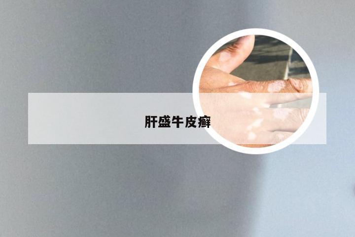 肝盛牛皮癣