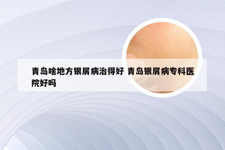 青岛啥地方银屑病治得好 青岛银屑病专科医院好吗