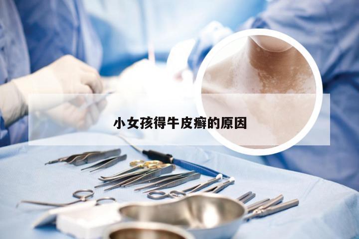 小女孩得牛皮癣的原因