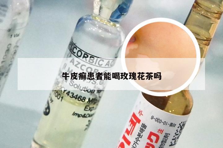 牛皮癣患者能喝玫瑰花茶吗