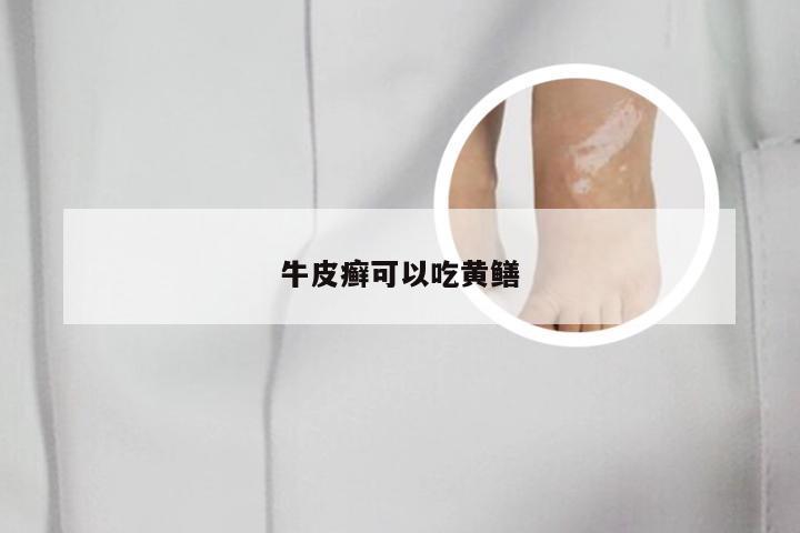 牛皮癣可以吃黄鳝