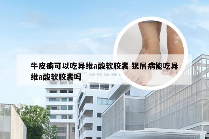 牛皮癣可以吃异维a酸软胶囊 银屑病能吃异维a酸软胶囊吗