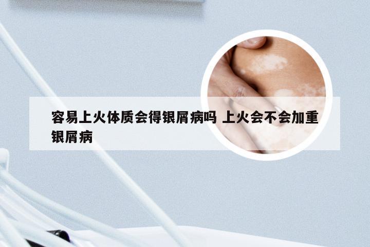 容易上火体质会得银屑病吗 上火会不会加重银屑病