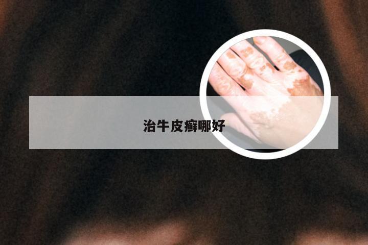 治牛皮癣哪好