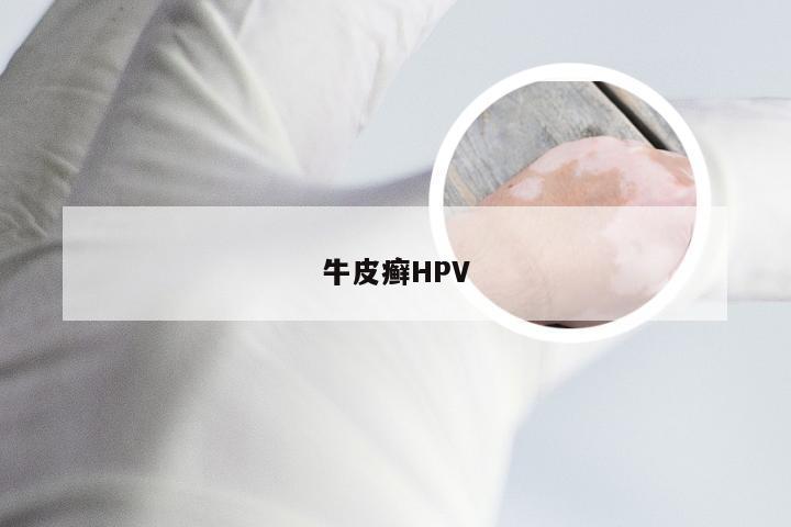 牛皮癣HPV