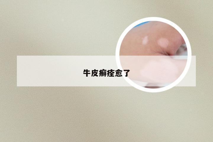 牛皮癣痊愈了