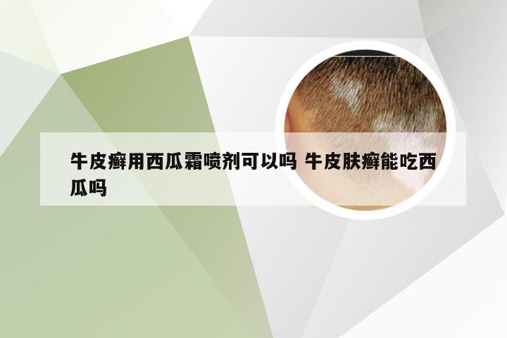 牛皮癣用西瓜霜喷剂可以吗 牛皮肤癣能吃西瓜吗