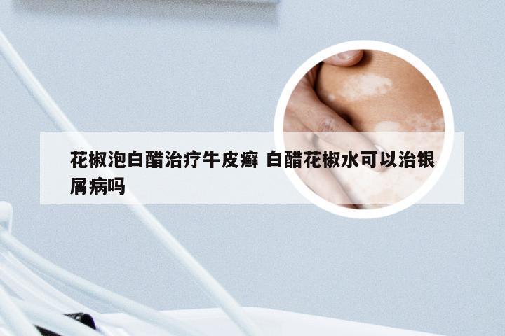 花椒泡白醋治疗牛皮癣 白醋花椒水可以治银屑病吗