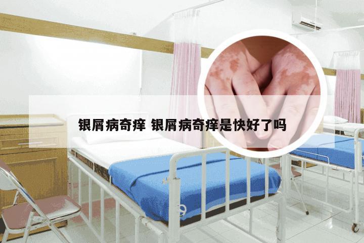 银屑病奇痒 银屑病奇痒是快好了吗