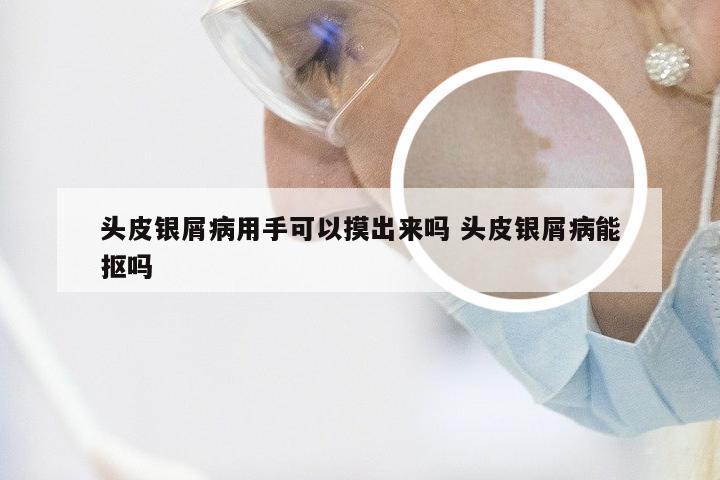 头皮银屑病用手可以摸出来吗 头皮银屑病能抠吗