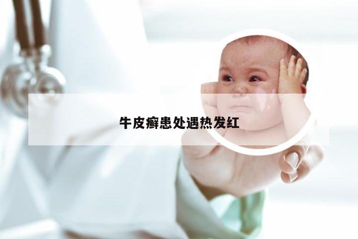 牛皮癣患处遇热发红