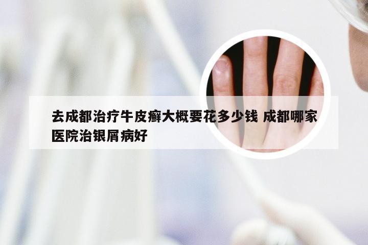 去成都治疗牛皮癣大概要花多少钱 成都哪家医院治银屑病好