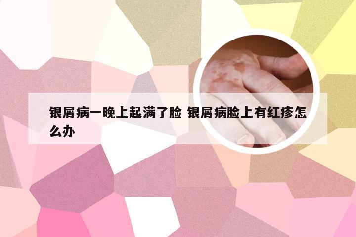 银屑病一晚上起满了脸 银屑病脸上有红疹怎么办