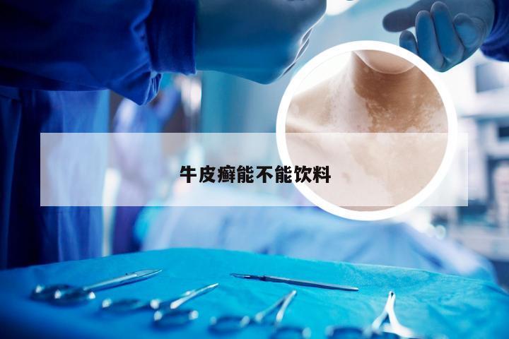 牛皮癣能不能饮料