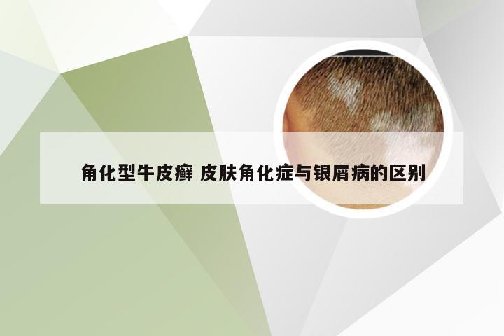 角化型牛皮癣 皮肤角化症与银屑病的区别