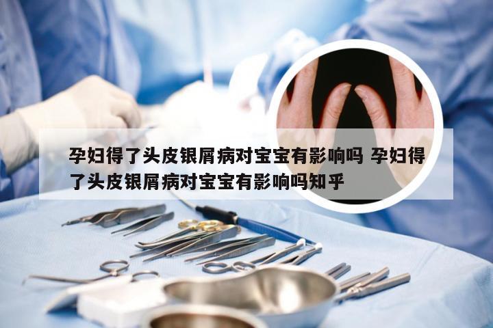 孕妇得了头皮银屑病对宝宝有影响吗 孕妇得了头皮银屑病对宝宝有影响吗知乎