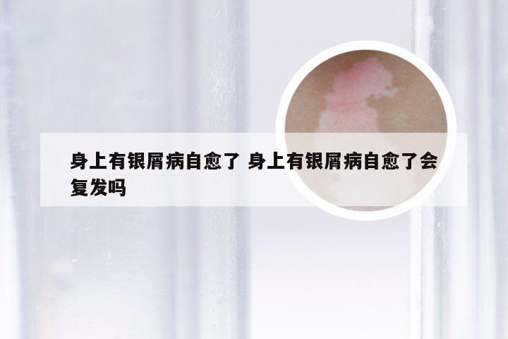 身上有银屑病自愈了 身上有银屑病自愈了会复发吗