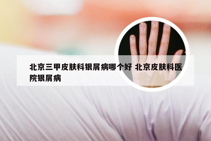 北京三甲皮肤科银屑病哪个好 北京皮肤科医院银屑病