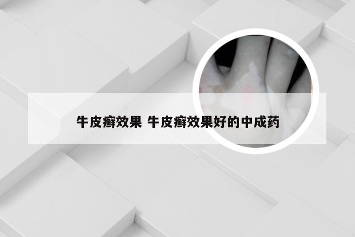 牛皮癣效果 牛皮癣效果好的中成药