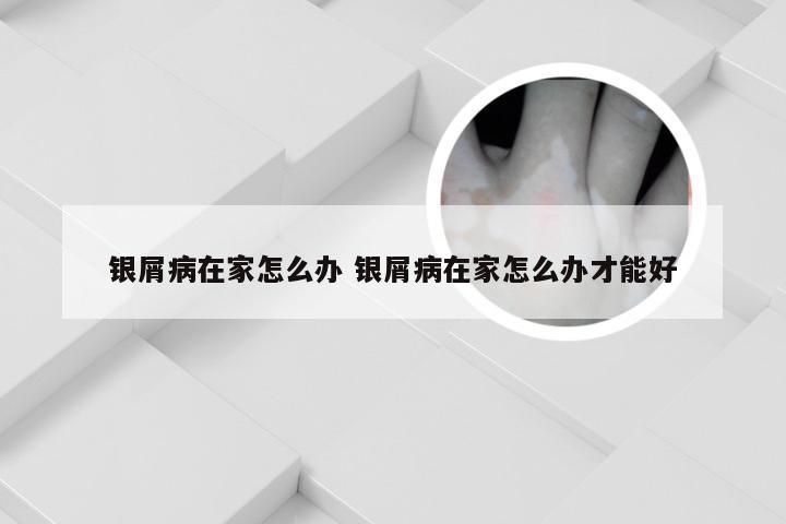 银屑病在家怎么办 银屑病在家怎么办才能好