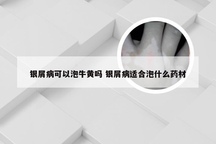 银屑病可以泡牛黄吗 银屑病适合泡什么药材