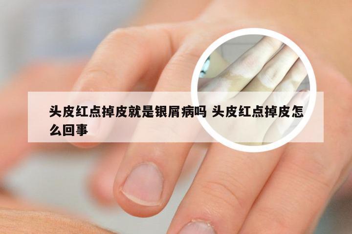 头皮红点掉皮就是银屑病吗 头皮红点掉皮怎么回事