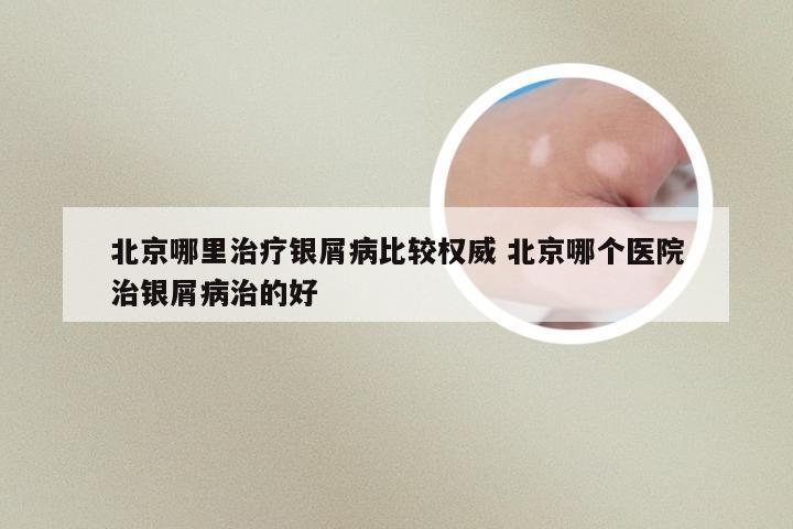 北京哪里治疗银屑病比较权威 北京哪个医院治银屑病治的好
