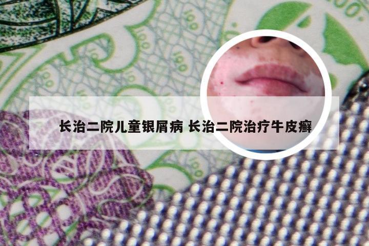 长治二院儿童银屑病 长治二院治疗牛皮癣