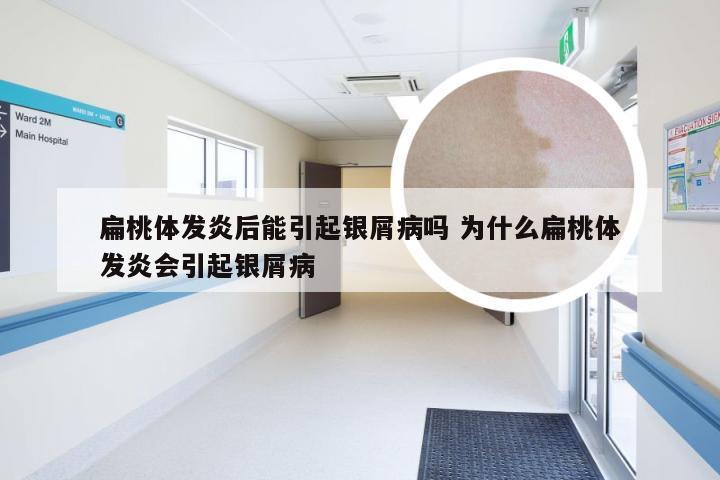 扁桃体发炎后能引起银屑病吗 为什么扁桃体发炎会引起银屑病