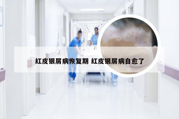 红皮银屑病恢复期 红皮银屑病自愈了