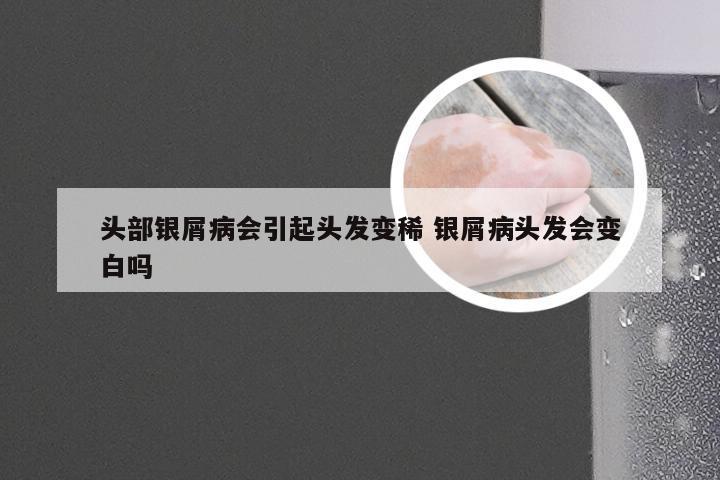 头部银屑病会引起头发变稀 银屑病头发会变白吗