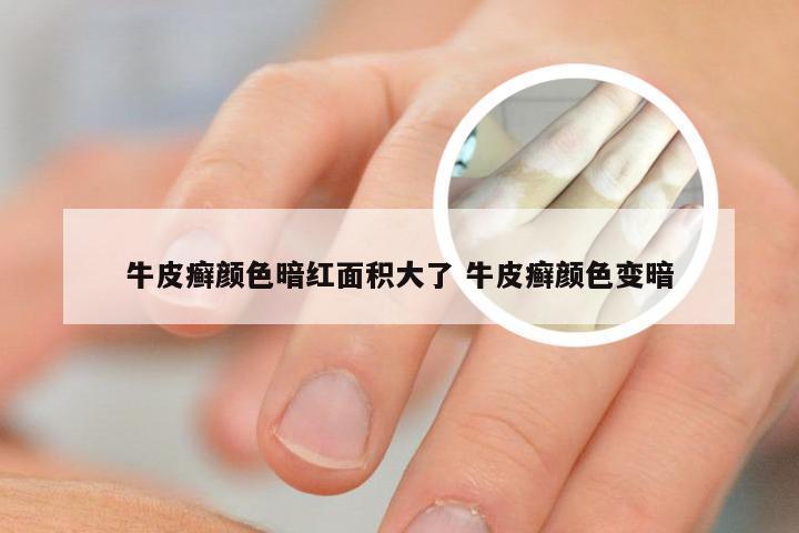 牛皮癣颜色暗红面积大了 牛皮癣颜色变暗